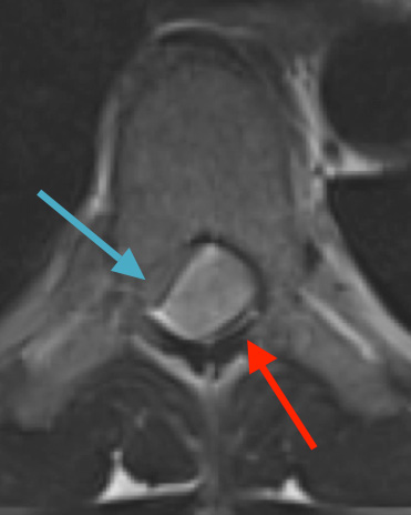 Thoracic Spinal Cord Tumor Case Presentation | NSPC Brain
