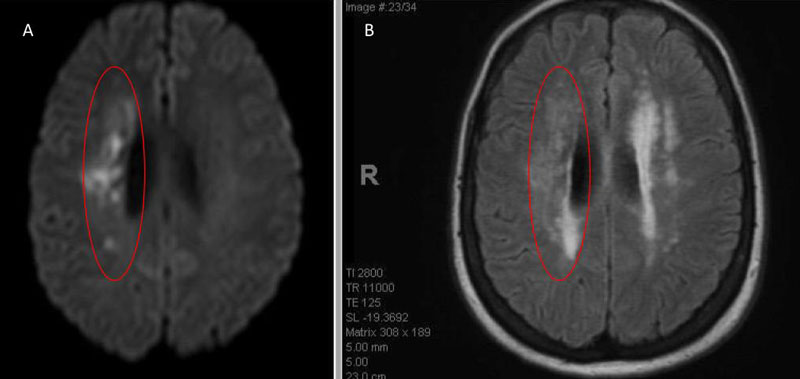 Symptomatic Near-Occlusion of the Carotid Artery | NSPC