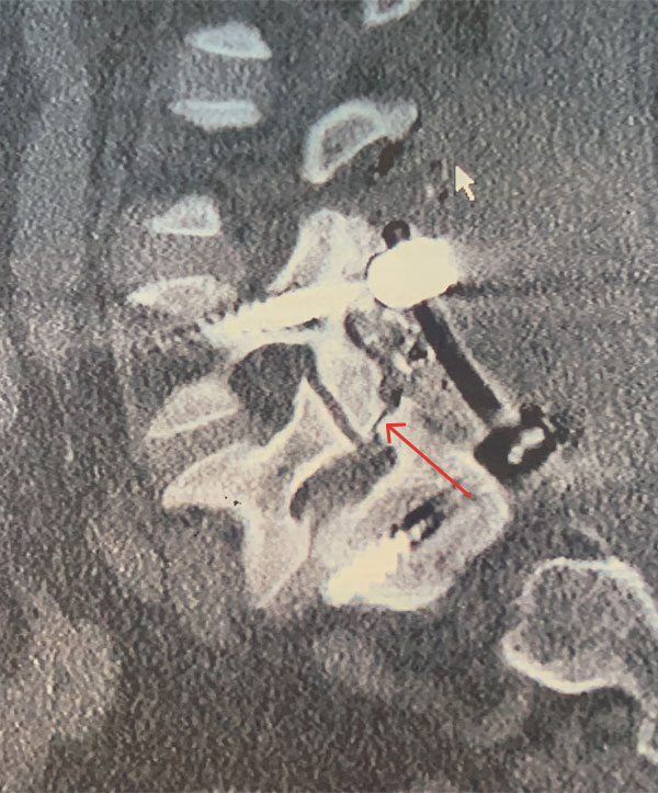 Sagittal CT image showing post placement of posterior segmental fusion L4-S1 construct