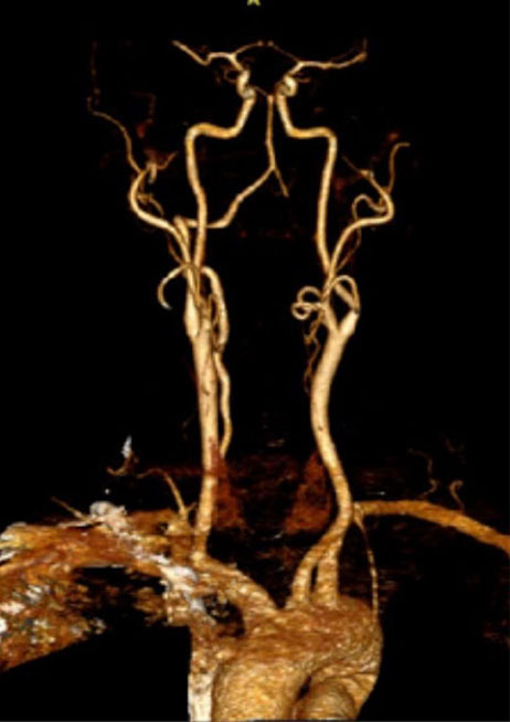 Right Vertebral Artery Compression Syndrome 3