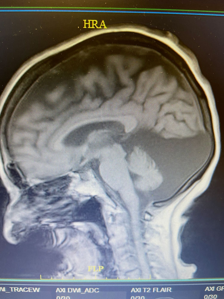 74 Year Old Woman with Occipital Headaches
