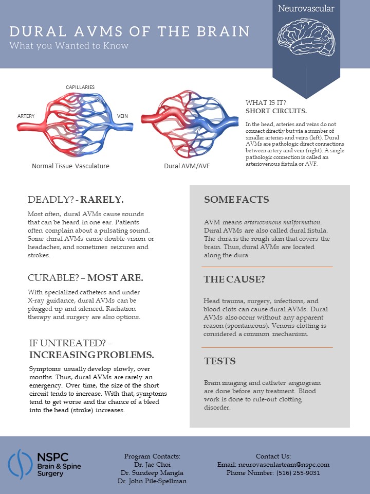 Dural AVMS of the Brain