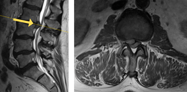 1B shows disc herniation at L2/L3