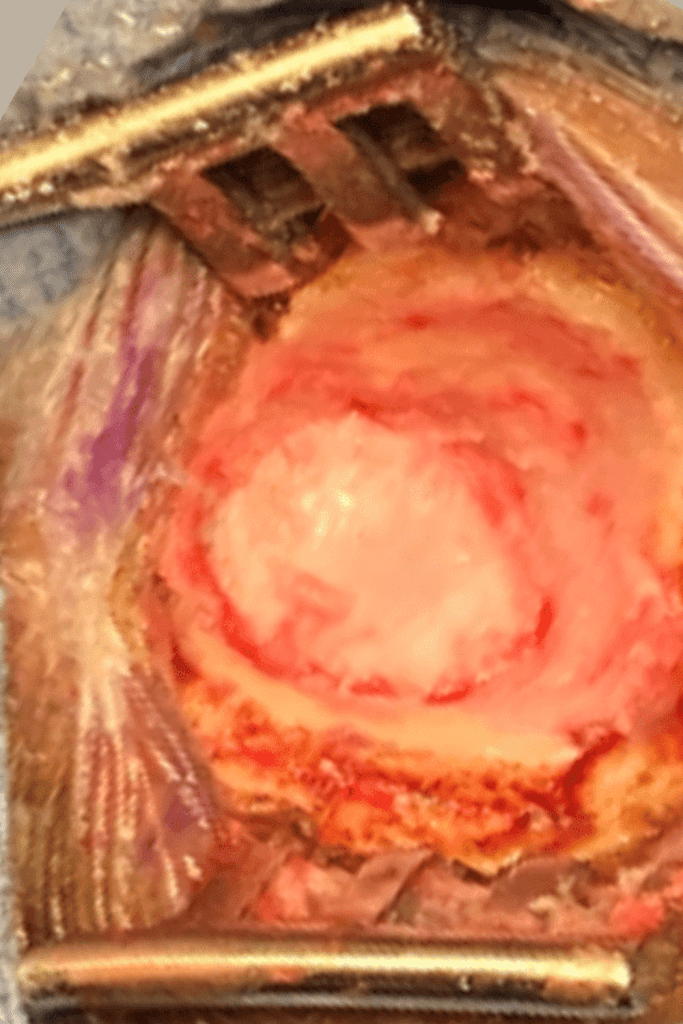 Surgical View of a Microvascular Decompression (MVD) for Trigeminal Neuralgia 5