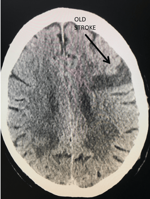 Unusual Indication for Carotid Stenting Over Endarterectomy 1