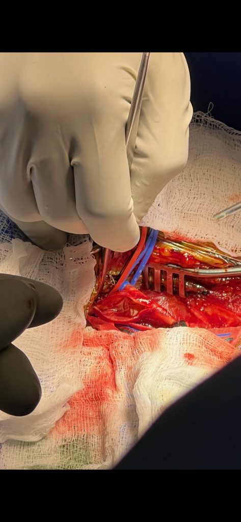 Image of the vessel after removal of the plaque