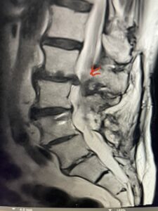 Fig. 1a Sagittal and axial T2 weighted lumbar and 1B L4-S1 instrumented fusion Fig 1A Sagittal and axial T2 weighted lumbar